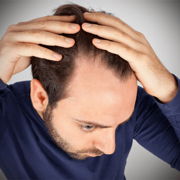 Alopezie